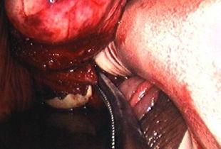 子宫全切视频教程,子宫全切手术操作步骤详解